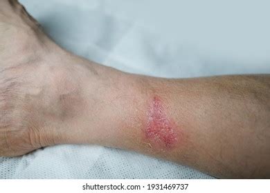 Skin Disease Lesion Ecchymosis Vasculitis Shutterstock