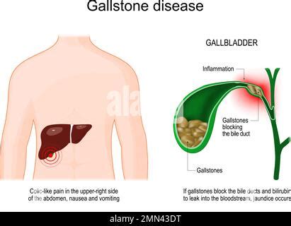 Gallstones Cholelithiasis Cholecystitis Inflammation Of The