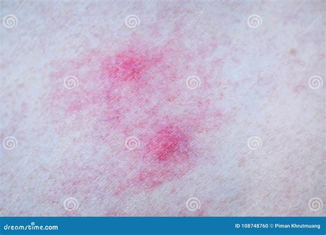 Skin Allergy From Mosquito Bites Stock Photo Image Of Back Patient