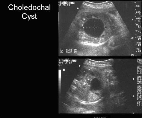 Ultrasound Classification Of Choledochal Cyst