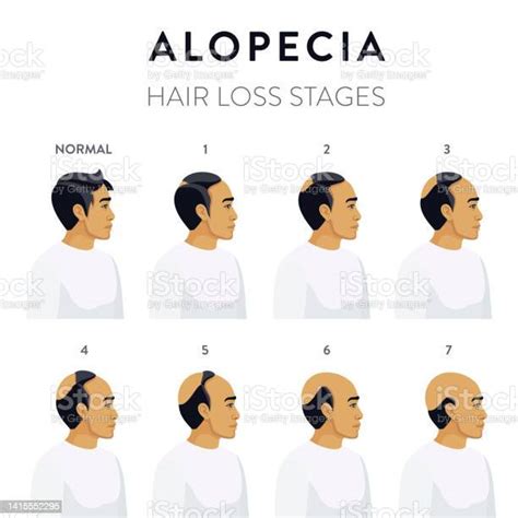 Ilustración De Alopecia Etapas De Pérdida De Cabello Y Más Vectores Libres De Derechos De