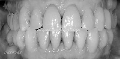 Caso clínico de ortodoncia avanzada e implantes dentales