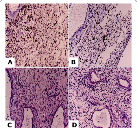 A D Hematoxylin And Eosin Staining Reveals Undifferentiated Sarcoma Of