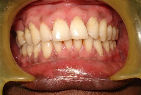 Pre Operative View Of Class 1 Recession In 11 And 21 In A Male Patient