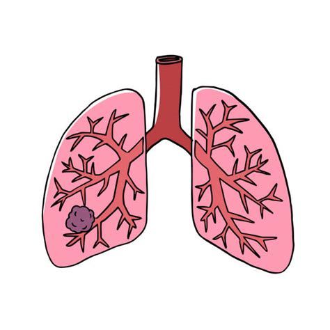 120+ Lung Cancer Drawing Stock Illustrations, Royalty-Free Vector ...