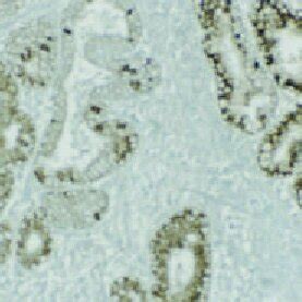 Immunohistochemical Staining For The Expression Of Survivin In Gastric