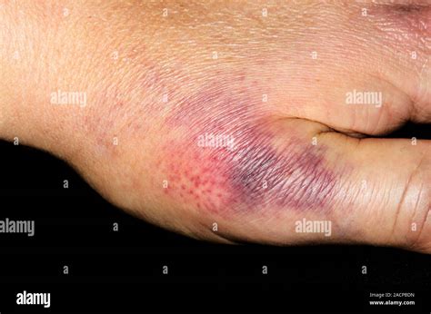 Bruising Around The Base Of The Thumb In A Year Old Female Patient