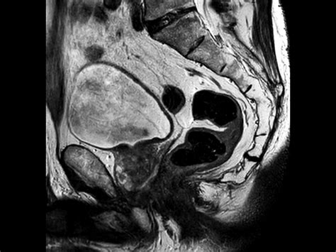 Mri Simulation For Prostate Cancer Treatment Philips Mr Body Map