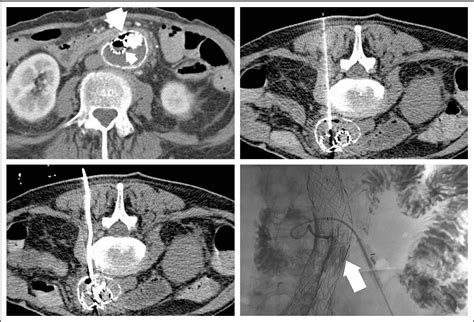 Figure 1 From Percutaneous Drainage Of Aortic Aneurysm Sac Abscesses