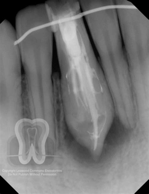 Dens in dente #25 - Leawood Commons Endodontics