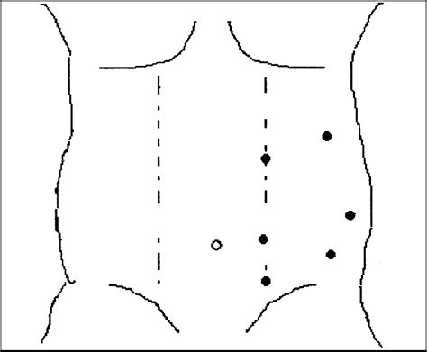 Figure 1 From Laparoscopic Retroperitoneal Lymph Node Dissection In The