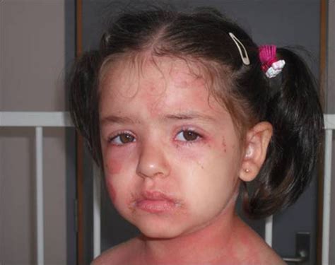 Staphylococcal Scalded Skin Syndrome Bmj Case Reports