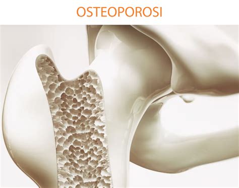 OSTEOPOROSI Sifa Formazione