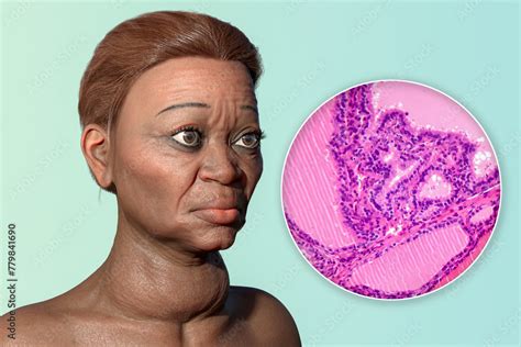 Graves Disease In A Woman 3d Illustration And Light Micrograph Of