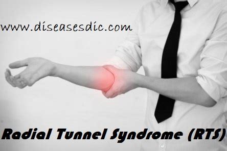 Radial Tunnel Syndrome (RTS) – Overview and Treatment.