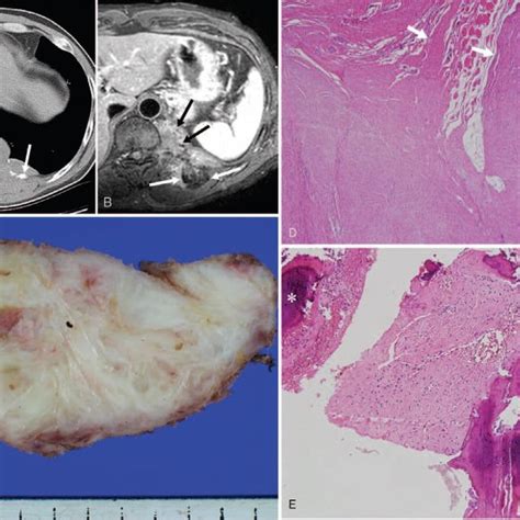 A Year Old Man Presented With Desmoid Type Fibromatosis In The Left