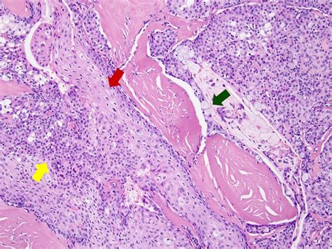 Mucoepidermoid Carcinoma Blog PathologyOutlines