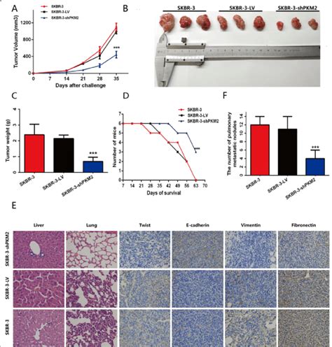 Rna Interference Against Pkm2 Inhibited Tumor Progression In Nude Mice