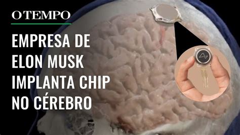 Chip No C Rebro Empresa De Elon Musk Anuncia Primeiro Implante Em