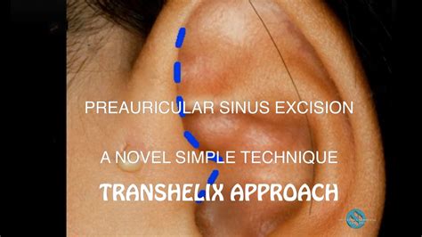 Preauricular Sinus Excision Trans Helix Approach Youtube