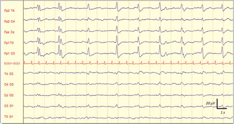 Representative Example Of Eeg Showing Periodic Discharges Pds In A