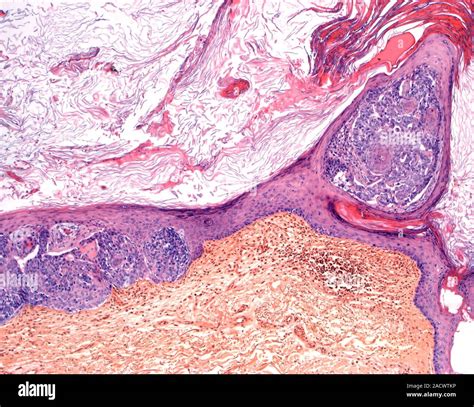 La Tiña Del Cuero Cabelludo Luz Micrografía De Una Sección A Través De Un Cuero Cabelludo