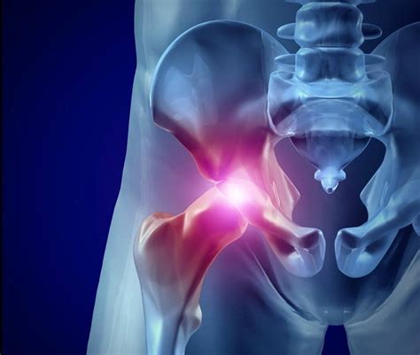 Hip Bursitis Laser Pain Therapy