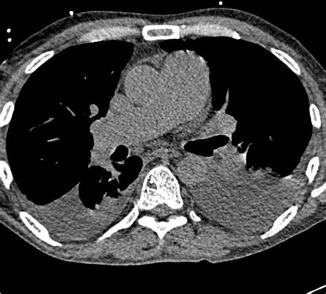 A Case Of Worsening Pulmonary Arterial Hypertension And Pleural