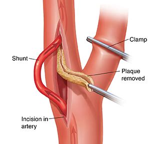 Understanding Femoral Endarterectomy Saint Luke S Health System