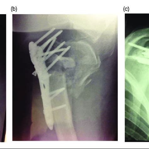 A Preoperative X Ray Anteroposterior View B Postoperative X Ray Download Scientific Diagram