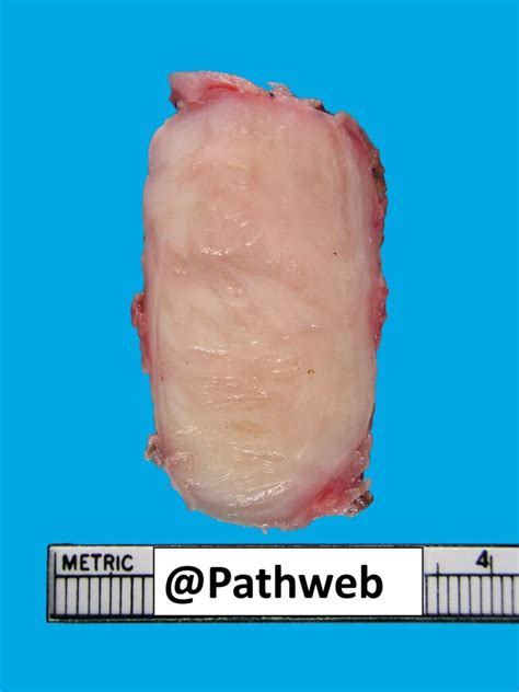 Oesophagus Leiomyoma Nus Pathweb Nus Pathweb