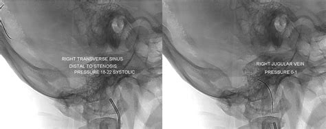 Case Archives Venous Pulsatile Tinnitus