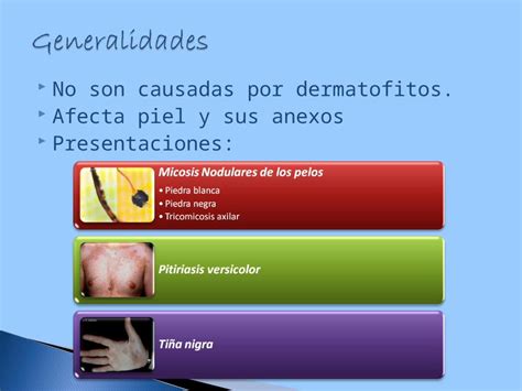 PPT 15 Micosis Superficiales DOKUMEN TIPS