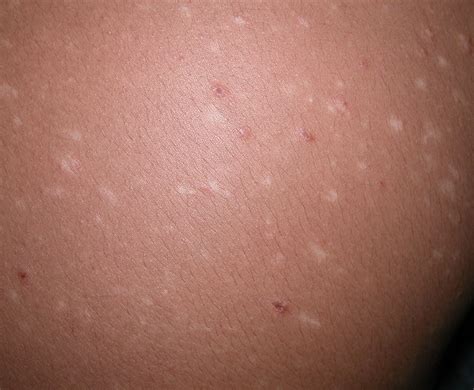 Pityriasis Lichenoides Medscape