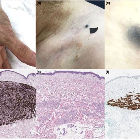 Bilateral Diffuse Uveal Melanocytic Proliferation B Dump A