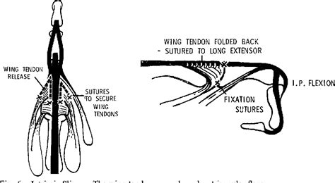 Figure 6 From Swan Neck Deformity In Rheumatoid Arthritis Of The Hand Semantic Scholar