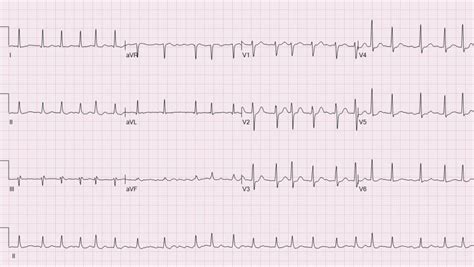 Blog Archives CARDIAC BOOTCAMP