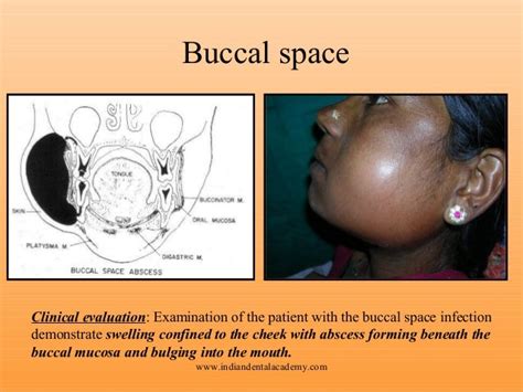 Space Infection Certified Fixed Orthodontic Courses By Indian Dent