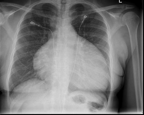 Chest Xray Showing Markedly Enlarged Heart Download Scientific Diagram