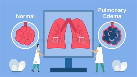 Edema Pulmonar Edema Pulmonar Fluido En Alveoli Esquema Anatómico