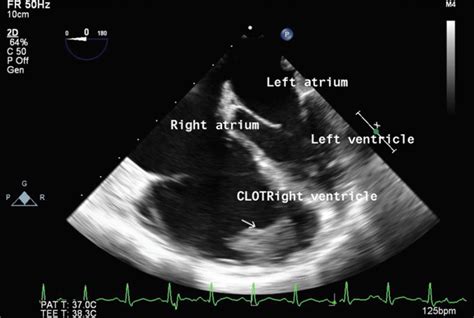 Isolated Right Ventricle Mass The Role Of Echocardiography In