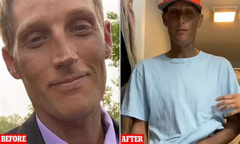 White Man Claims Bizarre Reaction To Prozac Turned His Skin Black