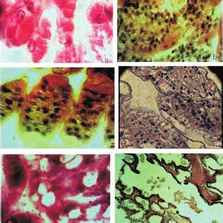 Histological Observation Of Severely WSSV Infected L Vannamei Shrimps