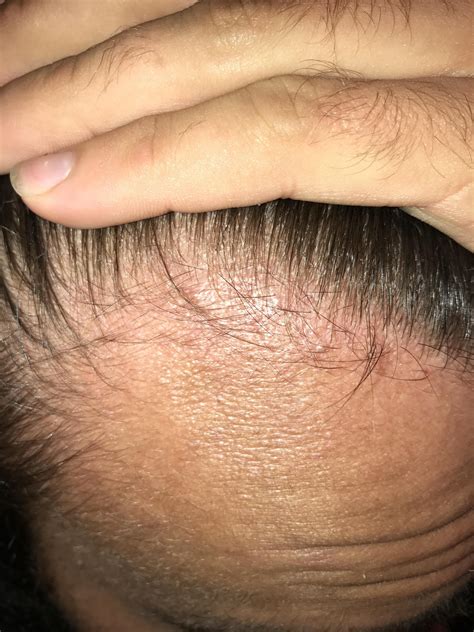 3 Month Minoxidil And 1 Month Finasteride Results Thus Far Tressless