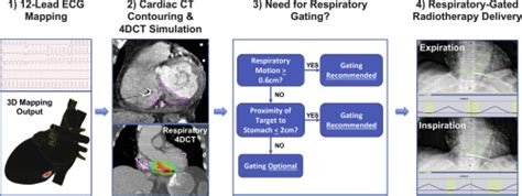 Computational Ecg Mapping And Respiratory Gating To Optimize