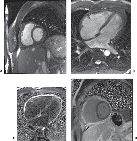 141 Pericardial Calcification | Radiology Key