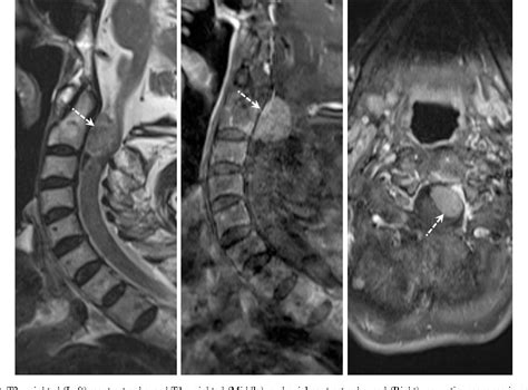 Figure 1 From Spinal Meningioma Causing Cervicothoracic Rotoscoliosis