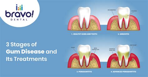 3 Stages Of Gum Disease And Its Treatments Bravo Dental Dallas