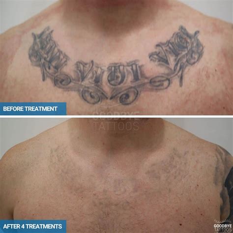 Pharrell Tattoo Removal Before And After Meyfiskairin