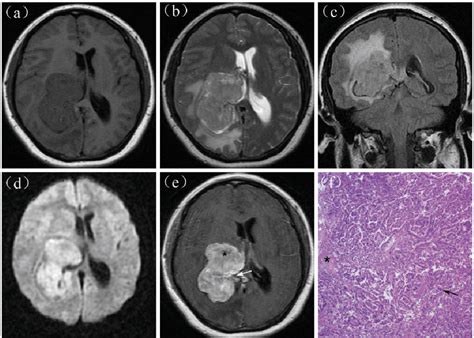 Atypical Choroid Plexus Papilloma Semantic Scholar